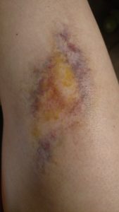 fx, sfx, fx makeup, bruise, healing bruise, sfx bruise